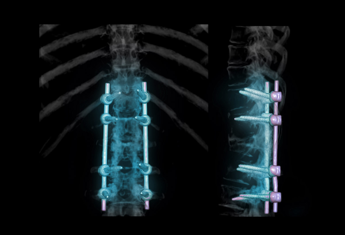 Lumbarization of the Spine - Seattle, WA - Brain and Spine Surgery