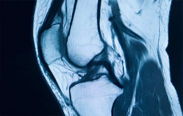 Difference Between MCL and ACL Tears | Proliance Puget Sound Orthopedics